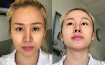 Sửa mũi nâng hỏng Hà Nội tại Bệnh viện Đông Á (Nguồn: Internet)