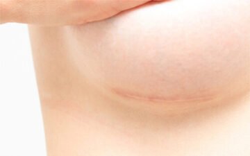 Chăm sóc sau sửa sẹo ngực là rất quan trọng để đảm bảo kết quả tốt nhất (Nguồn: Internet)