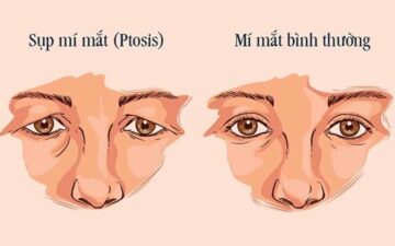 Tình trạng mắt sụp mí ( Nguồn: Internet )