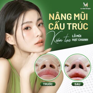 Thu nhỏ cánh mũi kết hợp nâng mũi mấu trúc cho nữ khách hàng xinh đẹp (Nguồn: MD Change Life)