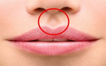 Thu ngắn nhân trung giá bao nhiêu? Bảng giá 2024