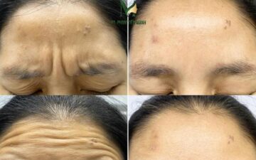 Kết quả tiêm cau mày tại Thẩm mỹ MD Change Life (Nguồn: MD Change Life)