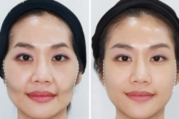 Tiêm má Baby giúp khắc phục những khuyết lõm trên vùng má giúp khuân mặt đầy đặn hơn (Nguồn: Internet)