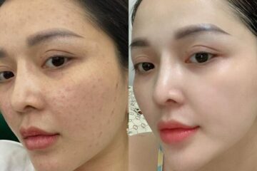 Trước và sau khi tiêm meso trị mụn, tàn nhang (Nguồn: Internet)