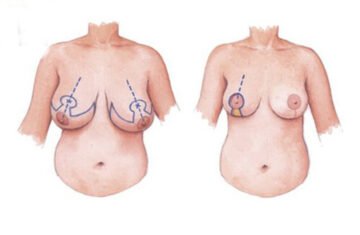 Nguyên nhân do tuổi tác là nguyên nhân phổ biến nhất (Nguồn: Internet)