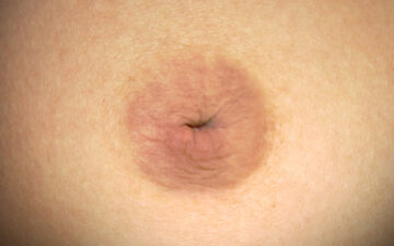 Tụt núm vú: Nguyên nhân và 3 cách khắc phục hiệu quả