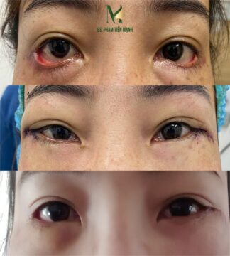 Thẩm mỹ MD Change Life- Địa điểm xoá rãnh lệ uy tín hàng đầu Nghệ An (Nguồn: MD Change Life)